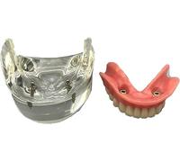 Modèle D'implant Dentaire - Prothèse Supra-mandibulaire Inférieure avec 2 Implants - Démonstration pour l'enseignement Et L'étude.