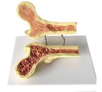 Modèle d'ostéoporose du fémur humain Anatomie Structure interne fémorale Squelette Pathologie Comparaison de contraste