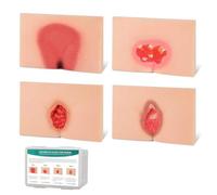 Modèle d'ulcère de décubitus en 4 étapes, modèle de plaies de pression avec détails de plaie réalistes pour la formation médicale, la pratique infirmière et l'éducation en classe