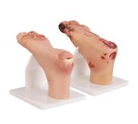 Modèle D'ulcère du Pied Diabétique, Modèle De Modifications Pathologiques des Ulcères du Pied, Étude De Pathologie Aux Stades Légers Et Graves, Outil De Formation Médicale