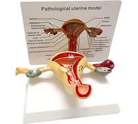 Modèle D'utérus-ovaire, Modèle D'utérus Humain, Utérus Pathologique et Modèle Anatomique D'ovaire Modèle D'utérus Malade pour Outil Éducatif de Bureau de Médecins