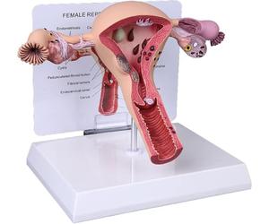 Modèle d'utérus pathologique féminin, ovaire Vaginal, enseignement | Modèle d'ovaire de l'utérus féminin, modèle d'anatomie for cabinet médical et salles de classe, outil éducatif