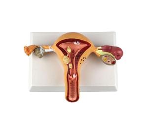 Modèle d'utérus pathologique présentant des maladies courantes. Représentation grandeur nature de l'organe reproducteur féminin montrant l'endométriose