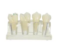 Modèle Éducatif de Dents Cariées en ABS Modules Détachables pour | Utilisation en Démonstration Médicale et Éducation la Santé, Communication Facilitée, Solide et Précis