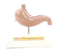Modèle Gastro-intestinal pathologique Lésions gastriques humaines Aides à l'enseignement Système digestif Modèle Médecine Enseignement Outil d'apprentissage