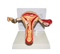 Modèle grandeur nature de l'appareil reproducteur féminin avec pathologies : utérus, ovaires, fibromes anatomiques, endomètre, cancer du col l'utérus