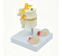 Modèle hernie discale lombaire 2 sections avec disques normaux protubérants | Modèle pathologie lombaire grandeur nature, disque normal, bombé, hernié avec compression nerveuse pour orthopédie