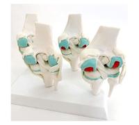 Modèle Humain Articulation du Genou Modèle D'anatomie avec Blessure Humaine, D'articulation Dégénérative en 4 Étapes Anatomique