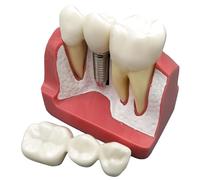 Modèle implant dentaire x4, couronne et bridge, restaurations amovibles, modèle de démonstration agrandi pour enseignement, support pour éducation du patient, avec section gingivale détaillée, 16 x 8