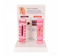 Modèle l’asthme Bronchique Détaillé, Comparaison Trachée B | Didactique, Éducatif, Maqute, Enseignants