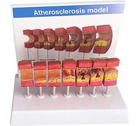 Modèle médical de pathologie artérielle athérosclérose, outil de démonstration de graisse des vaisseaux sanguins anatomiques pour une utilisation éducative et clinique