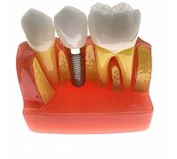 Modèle Oral D'enseignement Oral, Modèle De Solution D'implant 4X, Modèle De Restauration Prothétique Dentaire, Modèle D'implant De Pont Amovible pour La Recherche Pédagogique