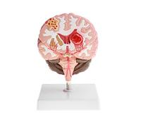 Modèle pathologique du Cerveau Humain Modèle de lésion cérébrale Modèle d'anatomie du Cerveau Humain Simulation de modè