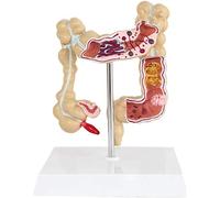 Modèle Pathologique du Côlon Humain 3D - Modèle De Lésion du Côlon Colorectal Modèle De Maladie Pathologique du Gros Intestin Modèle D'Anatomie D'Organisateur Médical