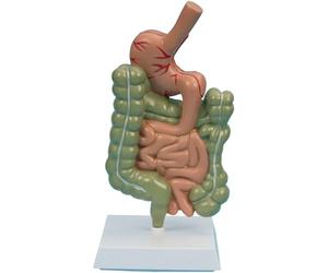 Modèle pathologique du système digestif, modèle de lésion du côlon humain, modèle de lésion gastro-intestinale du gros intestin for la recherche médicale sur les maladies intestinales.