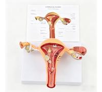 Modèle pathologique d'utérus et d'ovaires fibromes, kystes et endométriose