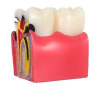 Modèle Pédagogique de Carie Dentaire pour Comparaison Visuelle 6x en | Usage en Hygiène Dentaire, en Milieu Médical, pour Dents et Lésions, Aide à L'enseignement