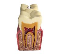 Modèle Pédagogique de Dents Amovibles pour étude Comparative des Caries, avec Section Transversale Visible