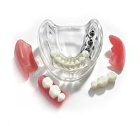 Modèle transparent d'implant dentaire Typodont avec 3 dents supérieures - Démonstration - Modèle détachable transparent - Modèle pédagogique dentaire adapté à l'enseignement et à l'étude