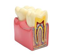 Modèles De Caries Dentaires,1 Pièce,6 Fois,Modèles De Comparaison,Modèle De Carie Dentaire,Enseignement De L'anatomie Dentaire,Modèle De Dentition