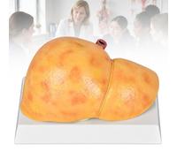 Modèles de Foie Anatomiques, Lot de 3 Foies Pathologiques Échelle 1:1,B