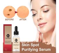 Mole Elimination Potion Mole Elimination Cream Repair Mole Black Spot Elimination Taupe Rose Huile Essentielle Solution De Soin De La Peau Hydratante