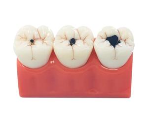 Muteitt Modèle De Dents De Carie Dentaire, Modèle De Dent D'éducation D'anatomie Dentaire, Outil De Typodont D'enseignement De Caries 4 Fois pour Les Étudiants Enseignants Dentistes
