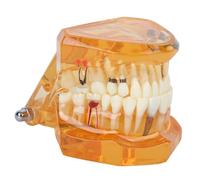 Natudeco Modèle de Dents avec Dents Amovibles,Modele Dentaire Pedagogique Transparent Dentaire Implant Disease Enseignement Étude Standard Dents Modèle pour l'enseignement
