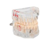 Natudeco Modèle Dentaire Modèle de dents d'implant dentaire transparent Modèle de dents pathologiques Modèle d'Enseignement Dentair pour Modèle d'éducation dentaire pour Médical et Dentiste