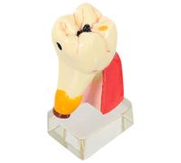 NESTINGHO Modèle Pédagogique de Dent 4 Caries, Matériau Solide et Portable, Utilisation en Enseignement Buccal