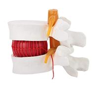 Nicfaky Modèle de démonstration de hernie discale lombaire humaine 1:1.5 pour l'anatomie humaine