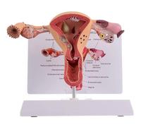 NURCIX Modèle d'utérus et d'ovaire, modèle pathologique de l'utérus Modèle d'organe reproducteur féminin pour l'enseignement de la gynécologie, démonstration à l'école