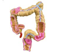 NZPOST Modèle d'anatomie d'organe Humain Modèle de lésion rectale et colique Modèle pathologique du Gros intestin pour hôpital anorectal