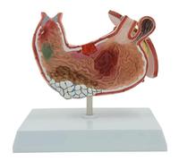 NZPOST Modèle d'anatomie d'organe Humain Modèle d'estomac pathologique avec diaphragme Modèle médical d'ulcère de gastrite pour Les Aides pédagogiques