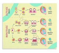 Obstetrics Placentation of Twins Chart Informative Poster Educational Wall Art Canvas Print for Hospital Office Decor(Framed,16x24inch(40x60cm))