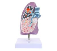 OHPHCALL Modèle Anatomique de Poumon Pathologique avec Structure Claire pour Enseignement Médical et Étudiants Effets du Tabagisme et Cancer du Poumon