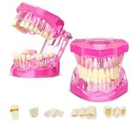 Okeeyseda Modèle de Dents Modèle de Dents de Maladie Typodonts Dentaires Modèle D'Implant de Dents avec Démonstration Pathologique de Dents Amovibles (Rose, 2 Pièces)