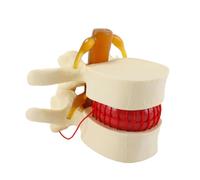 Orivin Modèle anatomique vertébral lombaire - Modèle de démonstration de hernie discale lombaire humaine 1,5X (jaune)