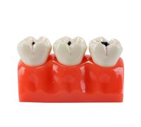 Orivin Modèle d'enseignement agrandi sur les caries dentaires, adapté à la communication dentiste-patient ou à l'enseignement en monstration de pathologie dentaire
