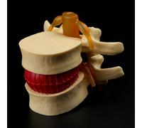 Outil D'enseignement Médical D'anatomie D'hernie De Disque Lombaire De Colonne Vertébrale Anatomique