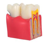 PartyKindom Modèle Pédagogique D'anatomie Carie pour Dentiste, Outil Typodont pour L'enseignement Résine, Modèle D'éducation du Atteint de Carie pour Formation en Santé Bucco-dentaire