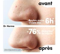 Patch Anti Bouton-Adapté Au Nez-Résultats En 6 À 8h-Testé Sous Contrôle Dermatologique-Acide Salicylique,Hydrocolloïdes,Huile D'arbre À Thé-Boîte De 10 Patchs