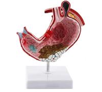 Pathologie gastrique modèle d'anatomie médicale anatomie humaine d'estomac ulcère gastrite outil d'apprentissage médical