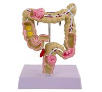 Pathologies humaines du gros intestin Modèle Médicaux Outil d'enseignement Anatomique Pathologies humaines de l'outil d'enseignement