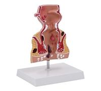 Pathologies humaines du rectum Modèle anatomique facile à utiliser Médicaux Aide pédagogique Anatomie Pathologies des fournitures pédagogiques scolaires