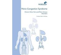 Pelvic Congestion Syndrome - Chronic Pelvic Pain And Pelvic Venous Disorders