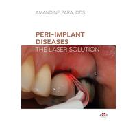 Peri-implant Diseases: The Laser Solution