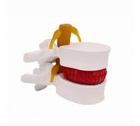 PETSOLA Modèle Protrusion Discale Discale | Modèle Colonne Lombaire Nerfs Spinaux, Qualité Médicale, pr n médicale, Professeurs D'anatomie,