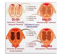Placentation of Twins Detailed Anatomy Canvas Wall-Art Obstetrics Educational Science Chart for Office Home Decor(Unframed,16x24inch(40x60cm))