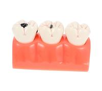 PRETYZOOM Modèle Blanche Agrandi Outil Pédagogique de Caries Dentaires Modèle Anatomique pour Enseignement et Communication Patient